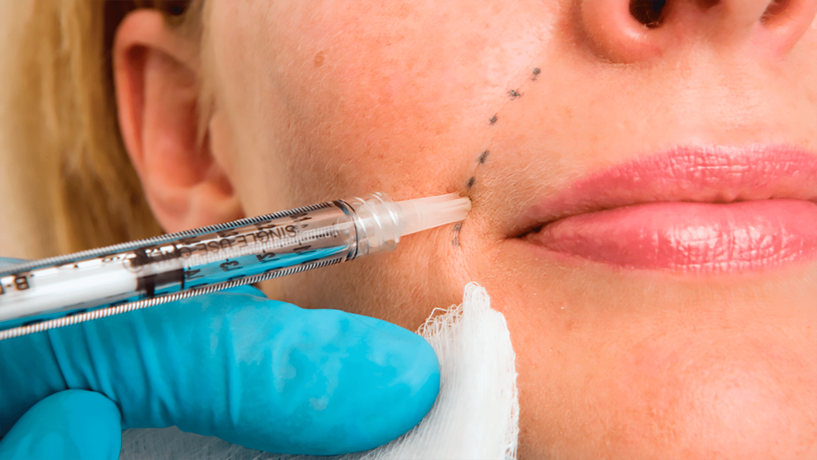 Filler & Body Reshaping | Transform Your Look 1 Filler