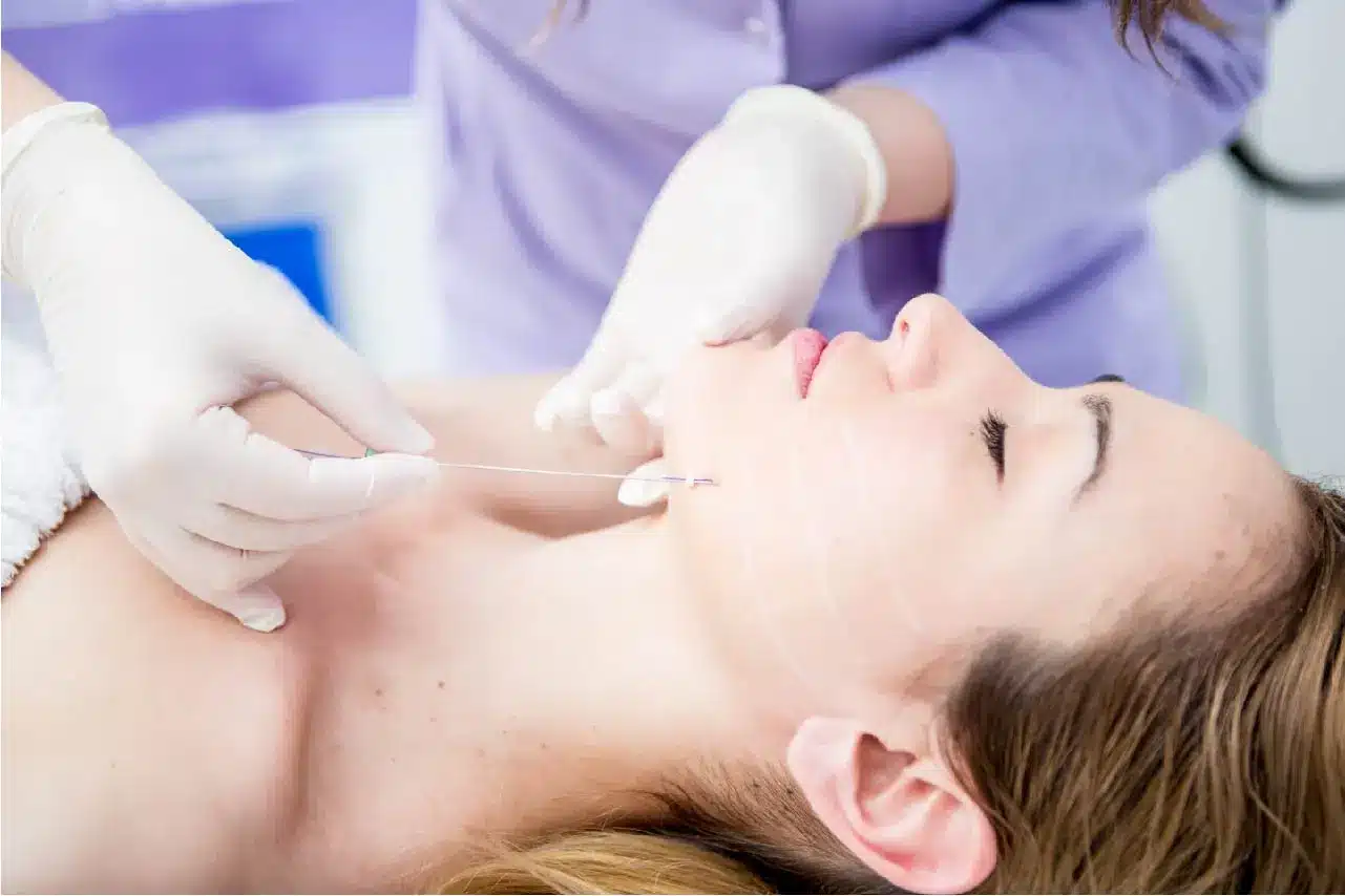 PDO Thread Lifts: 2025's Non-Surgical Facelift