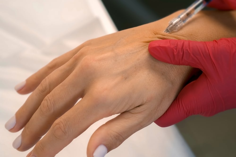 Restore Youthful Hands with Filler-Based Rejuvenation 1 Hands with Filler