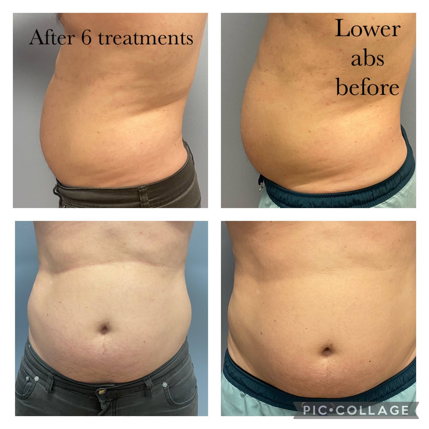 Non-Surgical Fat Reduction in Illinois | IntuMed Spa