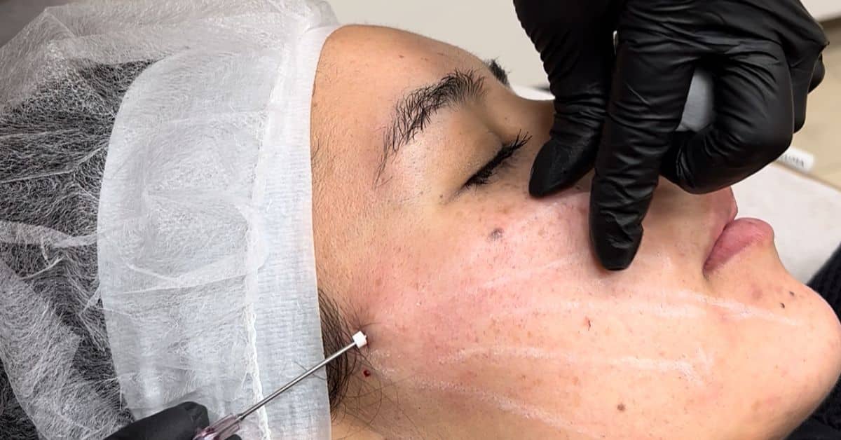 PDO Threads Lift | A Safe and Effective Way to Tighten and Rejuvenate Your Skin 1 1780100645 PDO Thread Lift 1