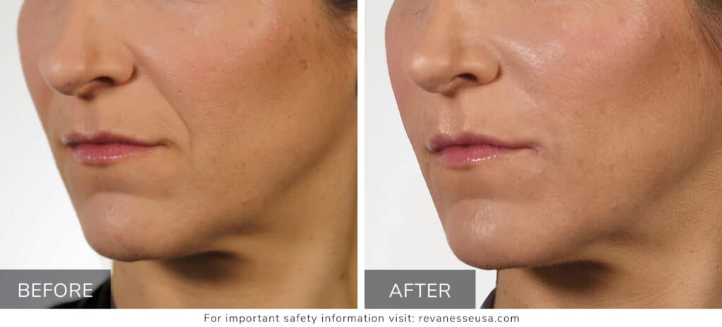 Cryo21 vs. Zemits Bionexis Lite Pro: Which is Best for You?