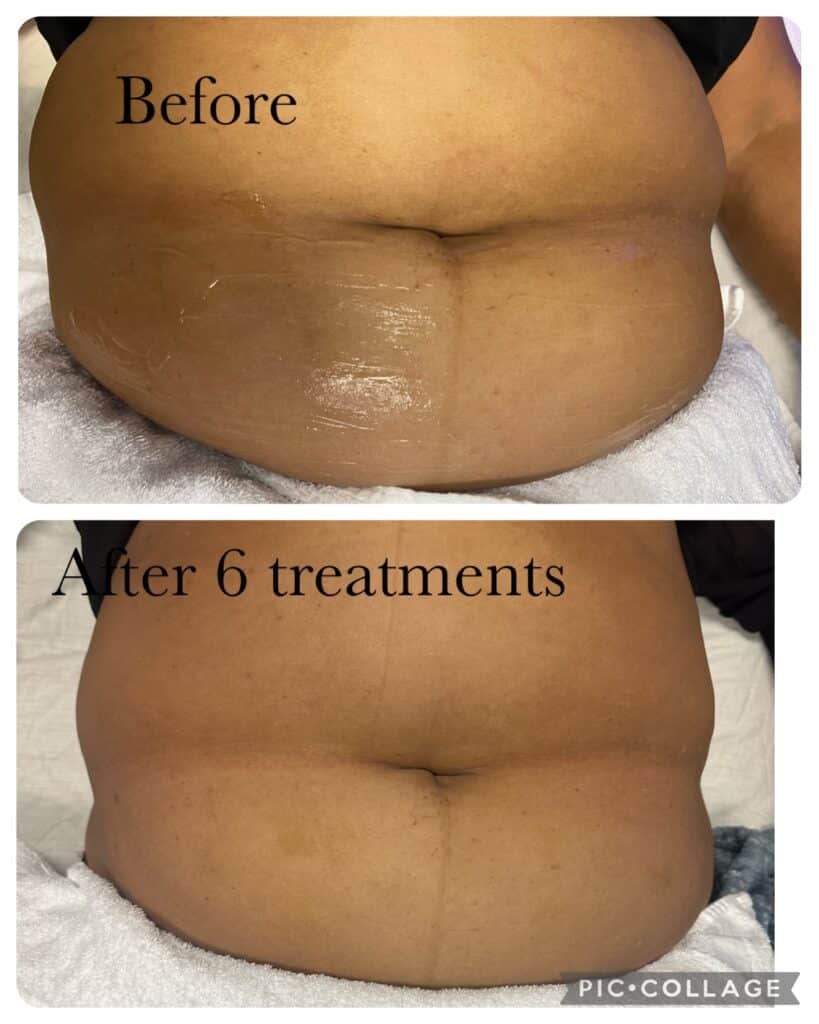Before and After Image: Body Sculpting – Abdomen - front