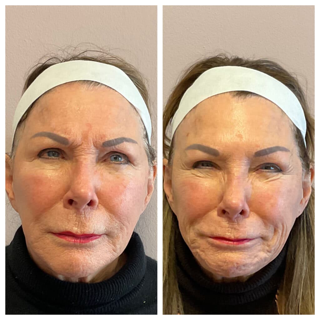 Before and After Image: Botox – 11’s & Forehead - front