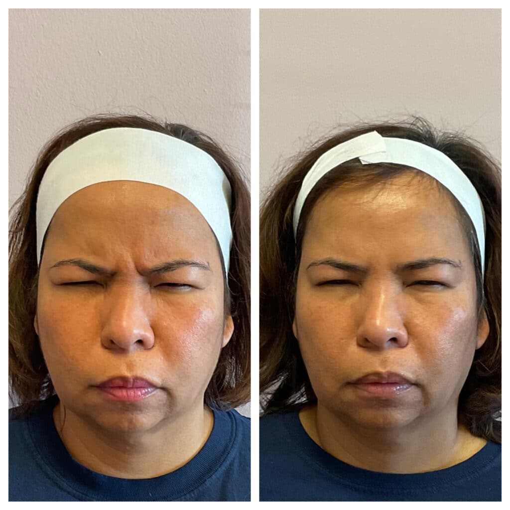 Before and After Image: Botox – 11’s & Forehead - front
