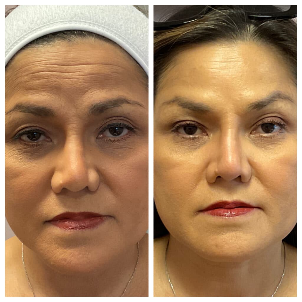 Before and After Image: Botox – Eyes & Forehead - front