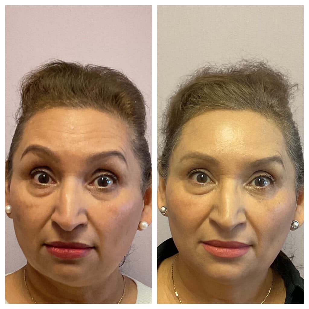 Before and After Image: Botox – Upper Face - front