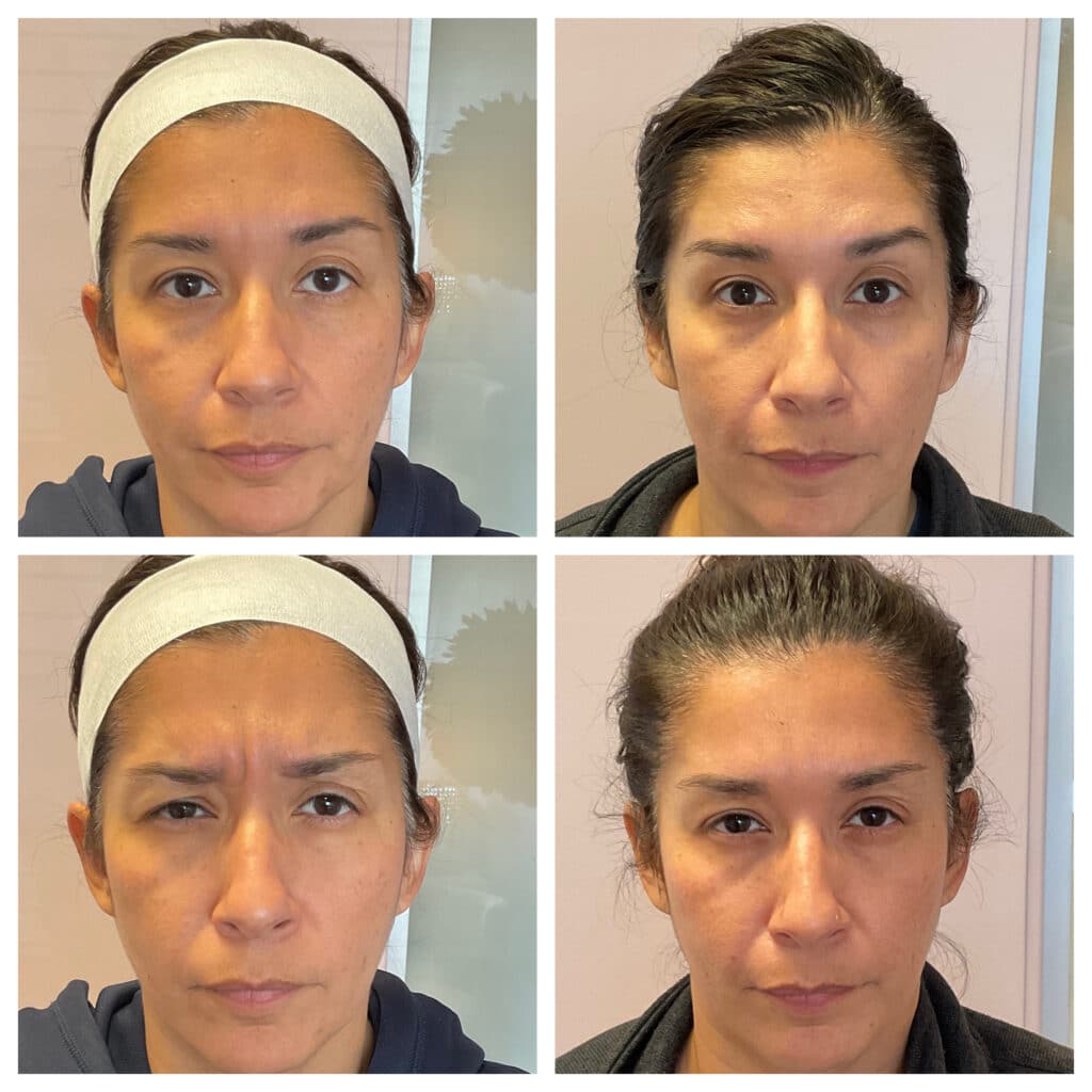 Before and After Image: Botox – Upper Face - front