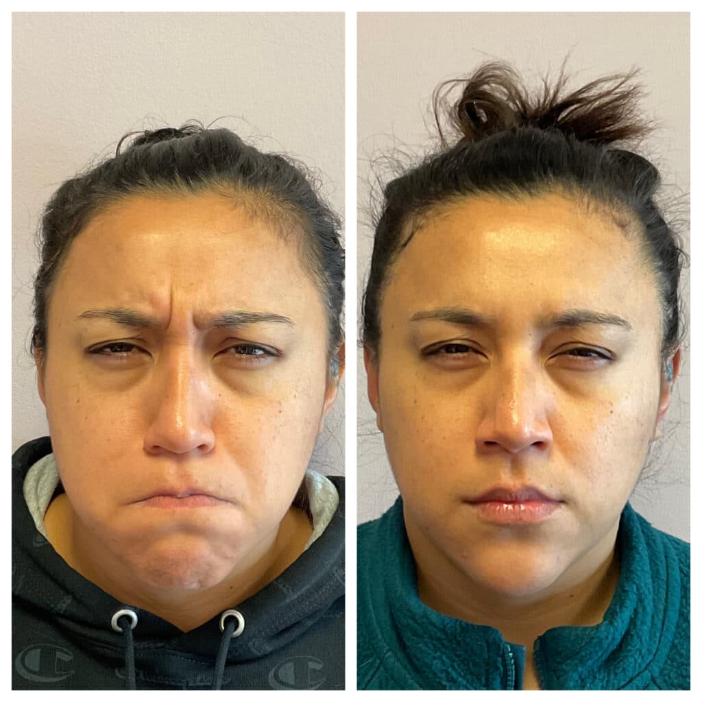 Before and After Image: Botox – Upper Face - front
