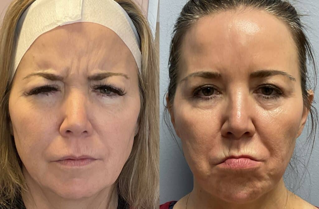 Before and After Image: Botox in Forehead - front