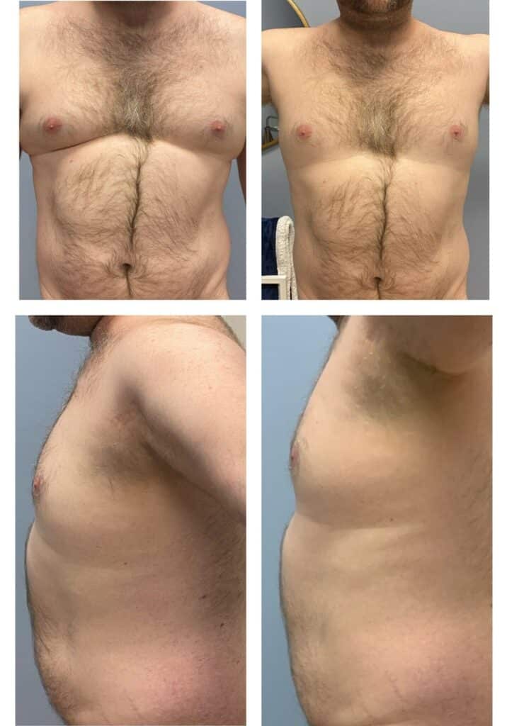 Before and After Image: Cryo21 Body Sculpting – Chest - front
