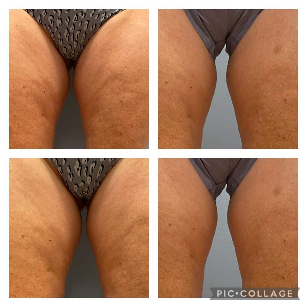 Before and After Image: Inner Thighs - front