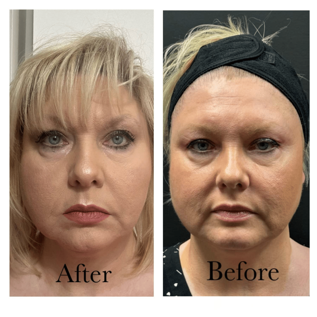 Before and After Image: PDO Threads – Eyes, Cheeks, Mouth - front