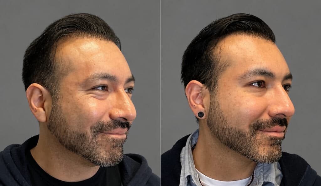 Before and After Image: Tox - right-side