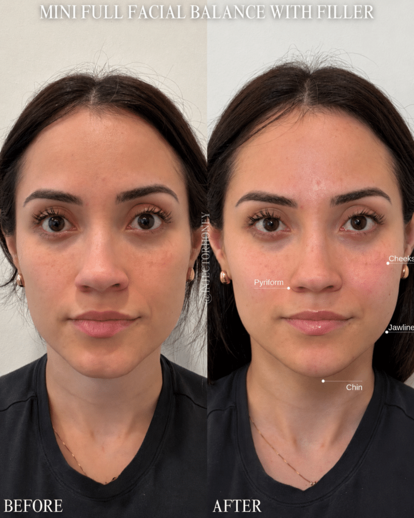Before and After Image: Mini Full Face - front