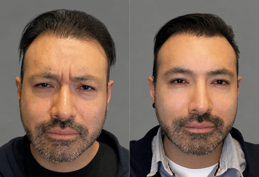 Before and After Image: Tox - front