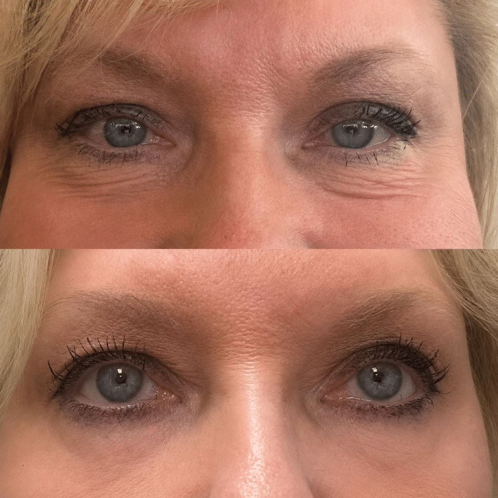 Before and After Image: Face Rejuvenation (Eyes) - front