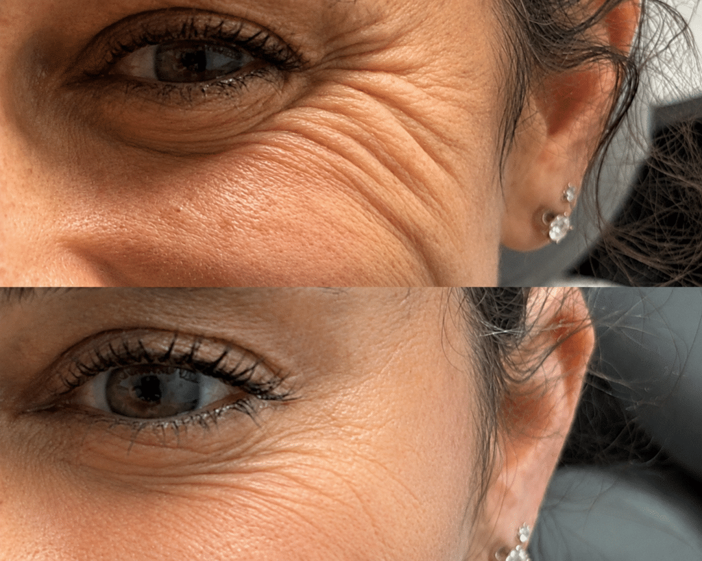 Before and After Image: Upper Face Rejuvenation (Eyes) - front