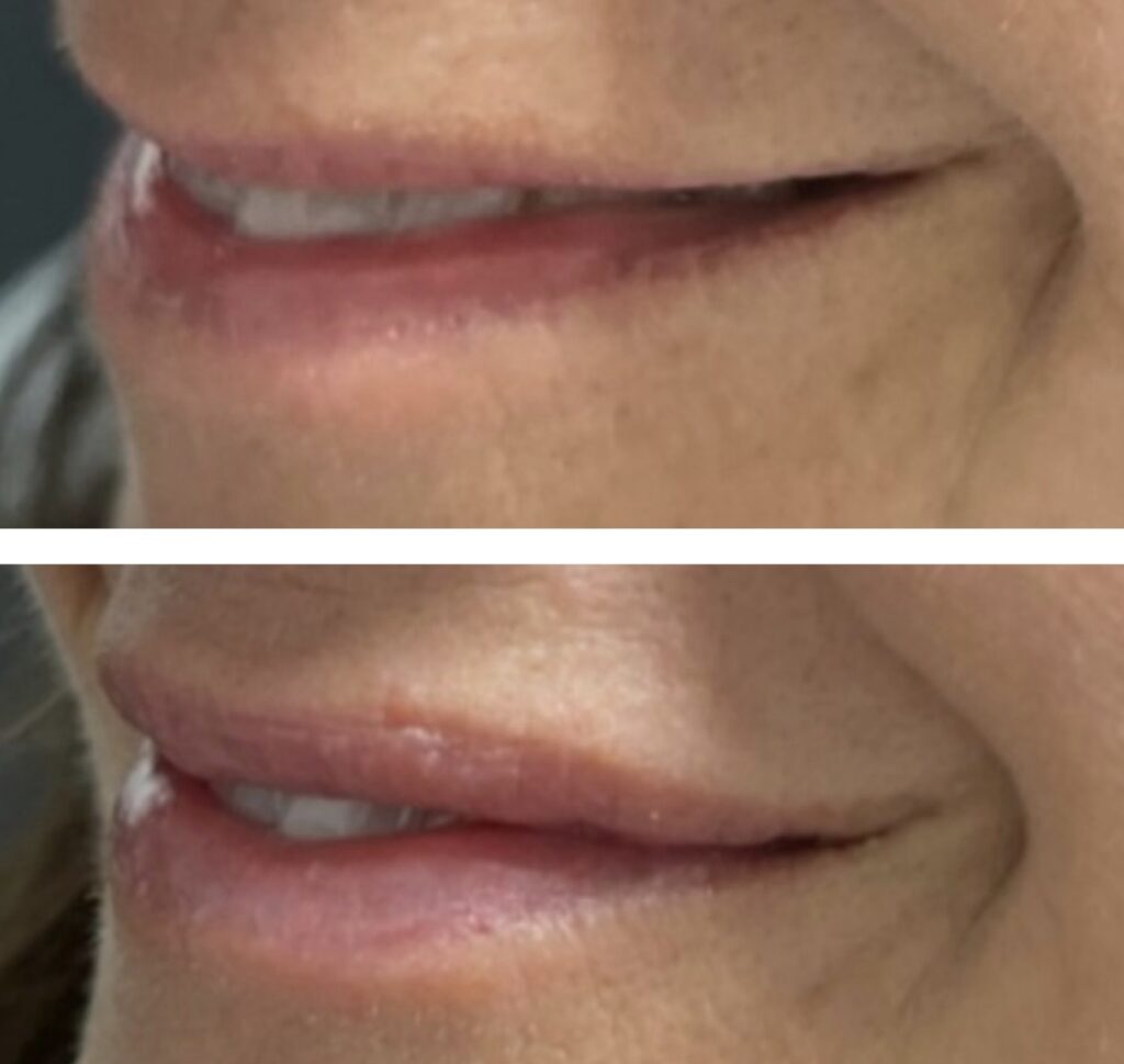 Before and After Image: Lip Hydration & Enhancement - left-front-oblique