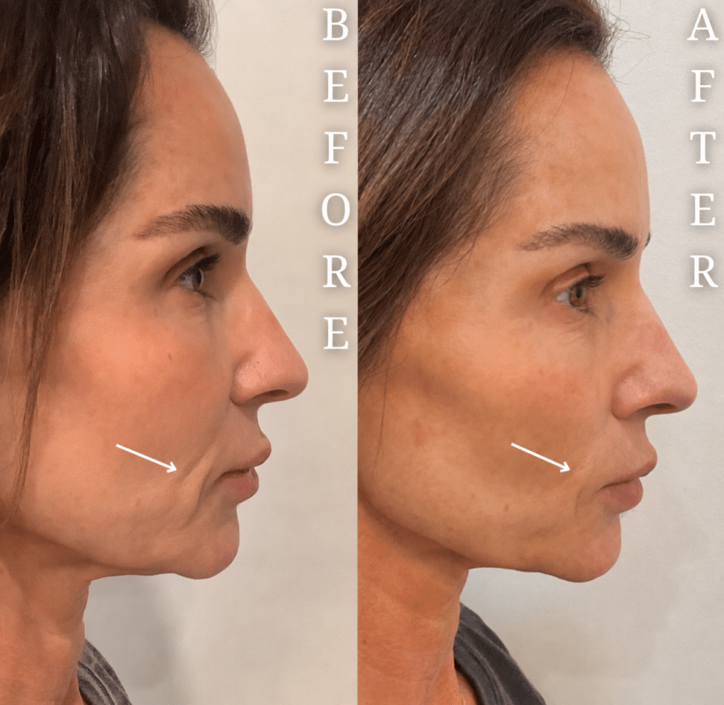 Before and After Image: Sculptra - front