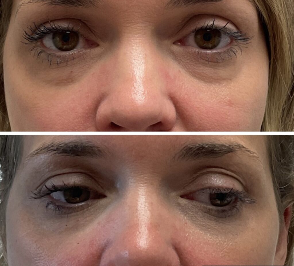 Before and After Image: Face Rejuvenation (Eyes) - front