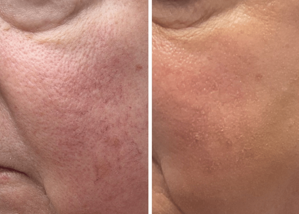 Before and After Image: Vascular Correction - front